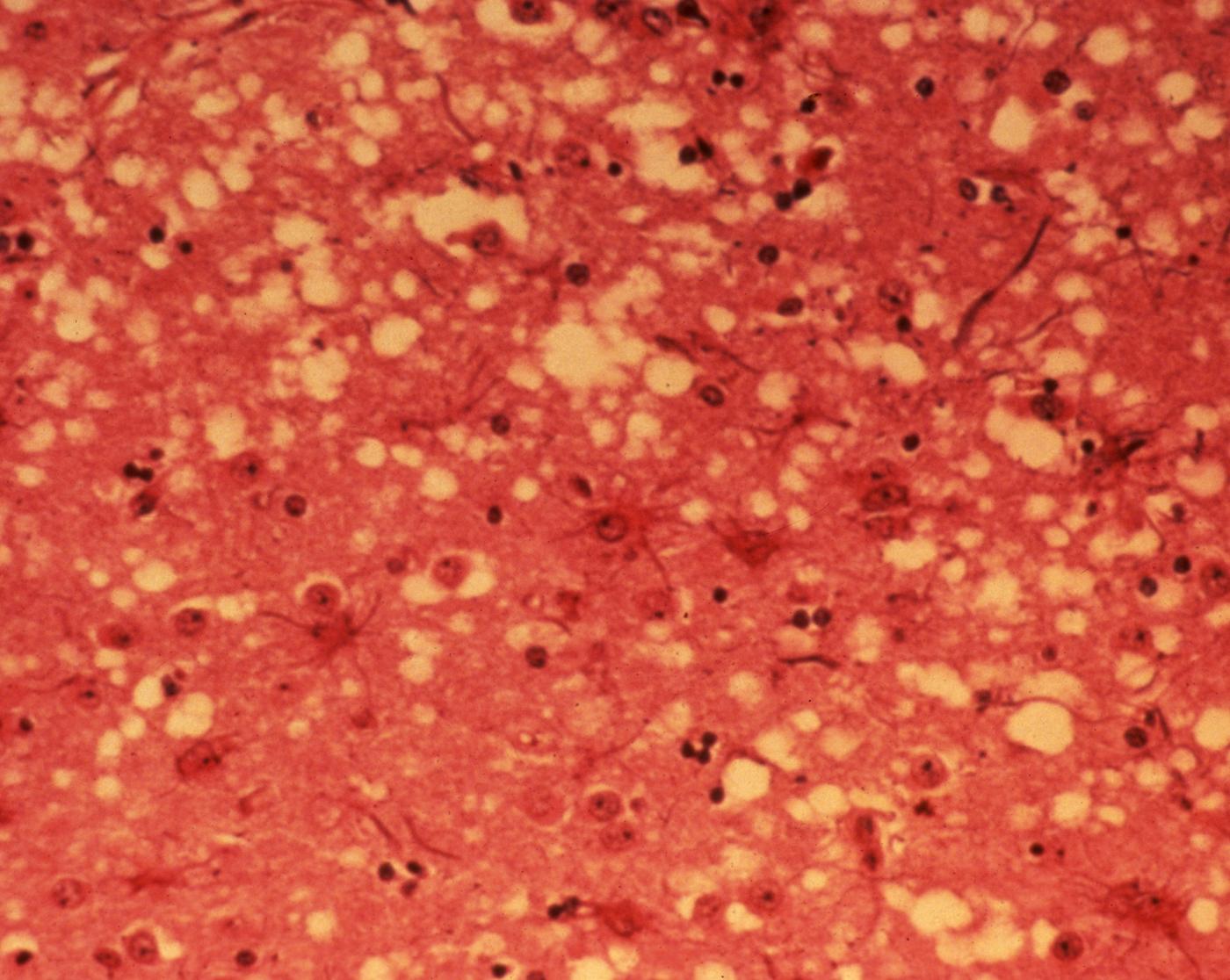 Micrografia de tecido cerebral com vacúolos, na doença da vaca louca